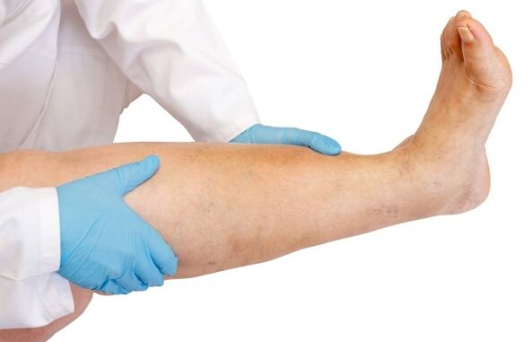 Gonflement des jambes